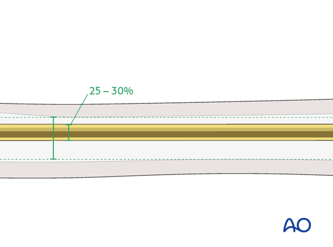 ESIN for Complete transtrochanteric, simple