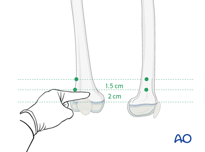 ESIN for Complete transtrochanteric, simple