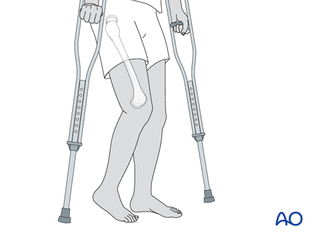 Nonoperative treatment for Avulsion of the greater or lesser trochanter