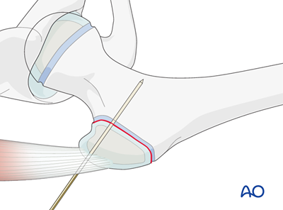 Open reduction, screw fixation (greater trochanter) for Avulsion of the ...