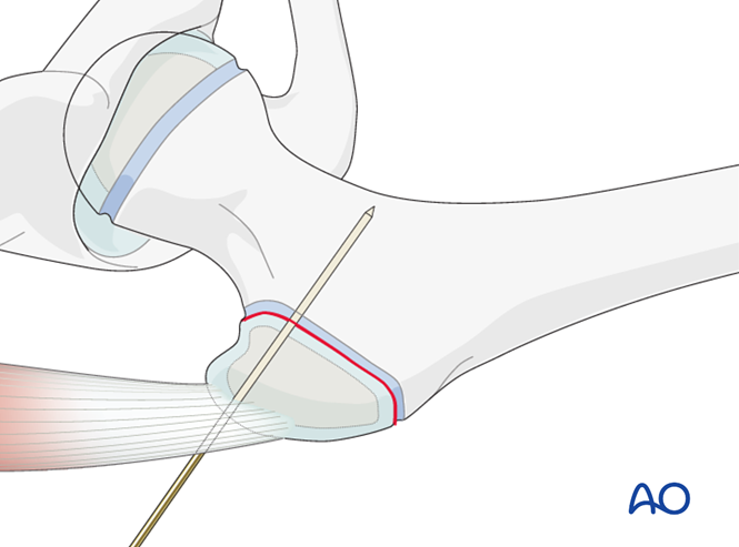 Open reduction, screw fixation (greater trochanter) for Avulsion of the ...