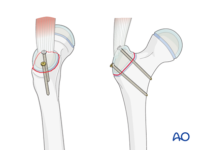 Open reduction, screw fixation (greater trochanter) for Avulsion of the ...