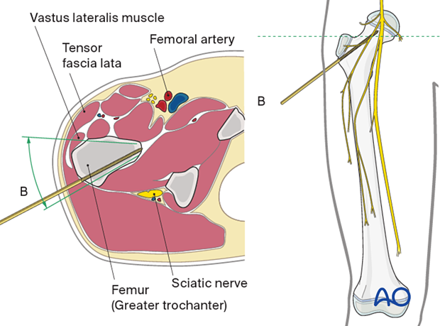 Safe pin placement through vastus lateralis and greater trochanter towards the femoral neck