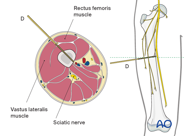 Anterolateral approach in the midshaft