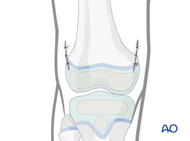 Wound closure