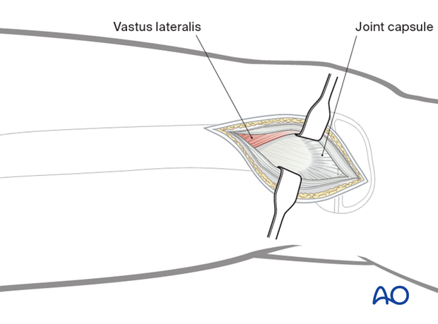 Mobilization and retraction of the vastus lateralis