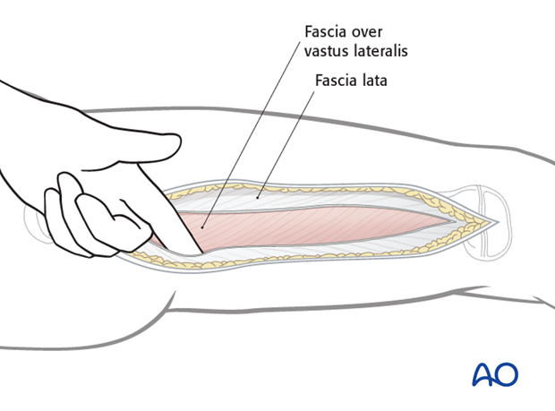 Separation of vastus lateralis from fascia lata