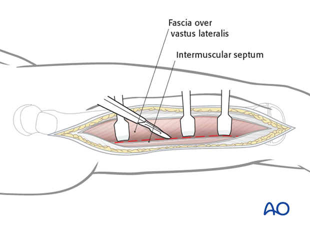 Incision of the fascia vastus lateralis