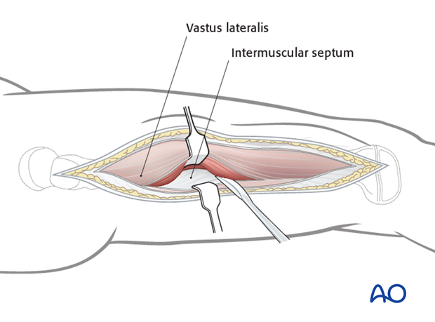 Mobilization of vastus lateralis from intermuscular septum