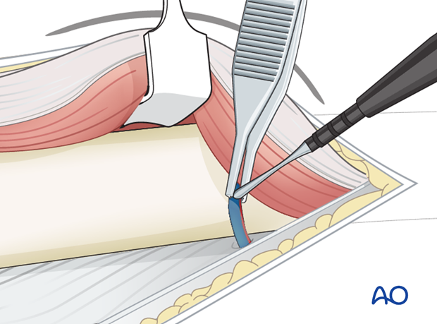 Cauterization of perforating vessels