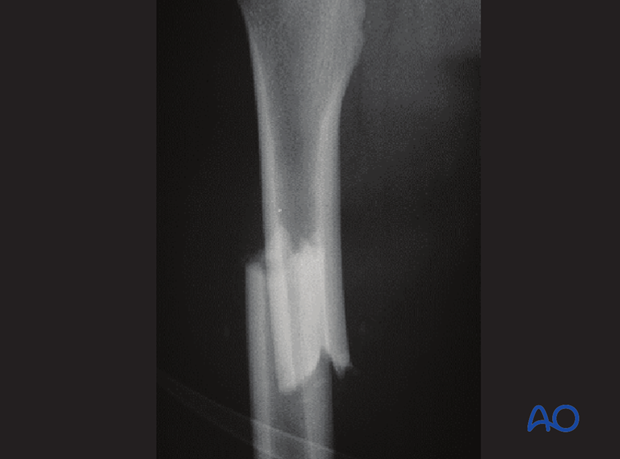 X-ray of a simple, complete transverse femoral shaft fracture
