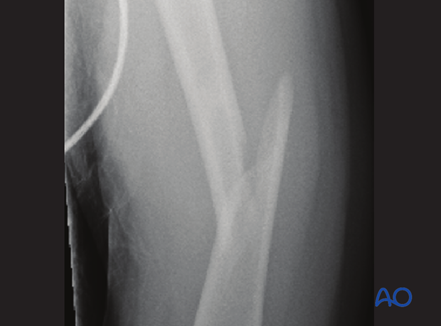X-ray of an oblique middle-third femoral shaft fracture