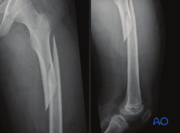 X-ray of a long oblique proximal-third femoral shaft fracture