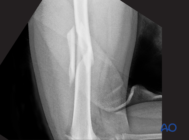 X-ray of a multifragmentary fracture