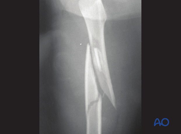 X-ray of an isolated multifragmentary femoral shaft fracture