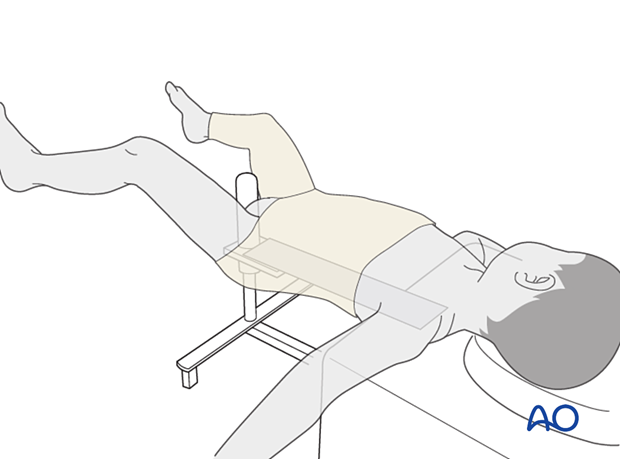 Placement of patient of hip spica box