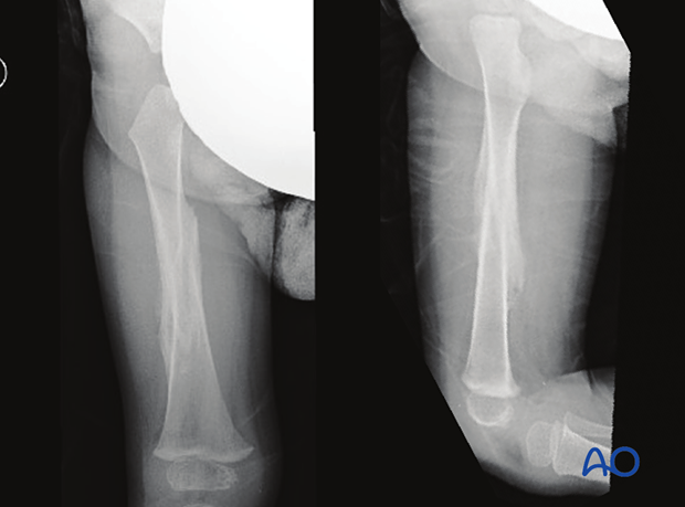 X-rays after removal of spica cast
