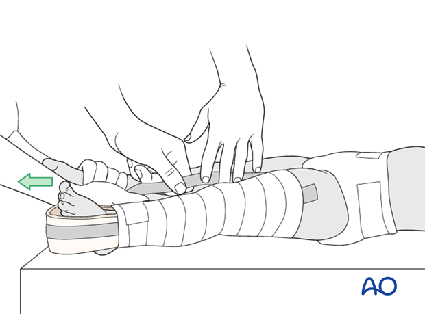 Application of stirrup on injured leg with assistant