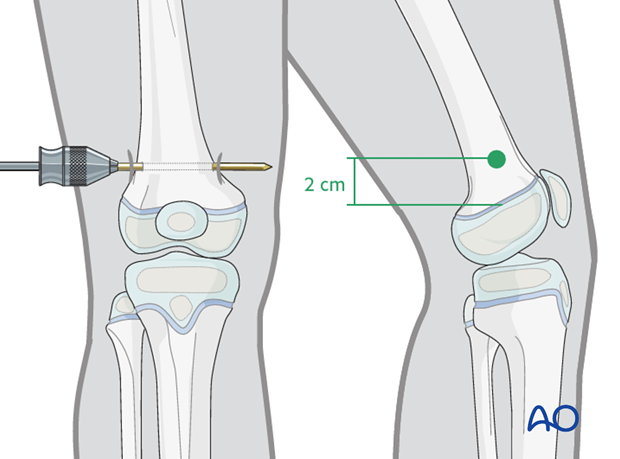 Insertion of pin in the distal femur