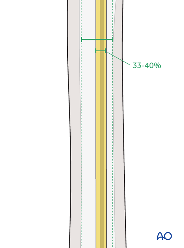 Nail diameter should be 33–40% of narrowest part of medullary canal.