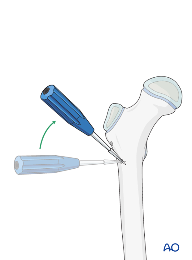 Opening the distal entry point
