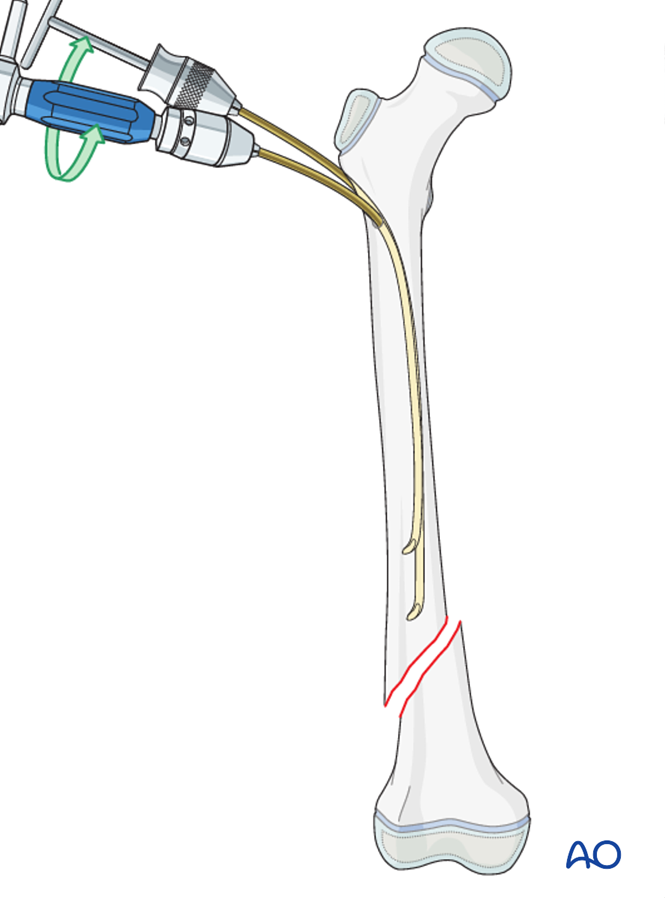 ESIN (antegrade) for Complete oblique or spiral, simple