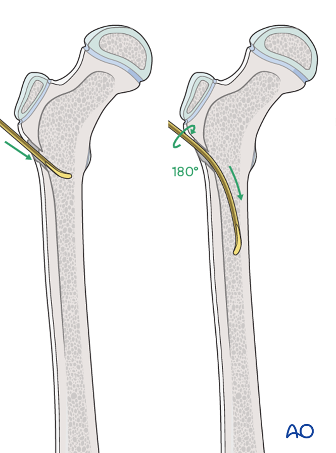 ESIN (antegrade) for Complete oblique or spiral, simple