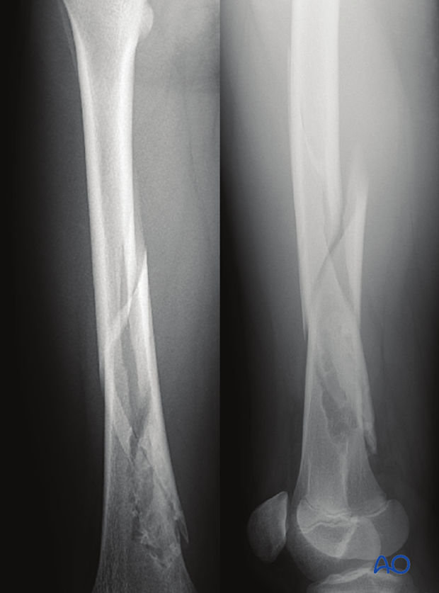 AP and lateral view x-ray of fracture