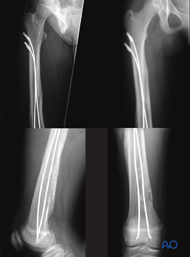 X-rays three-month post injury