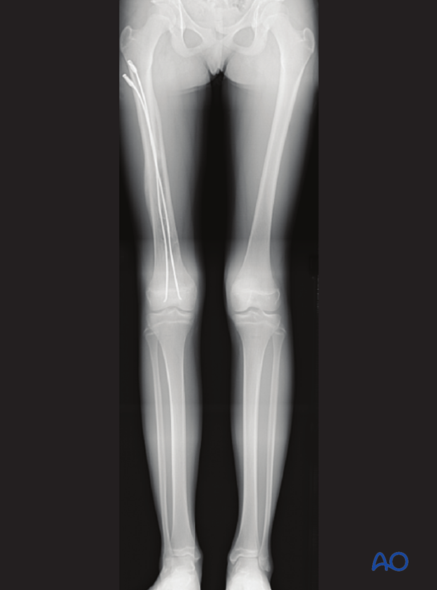 Long-leg x-ray one-year post injury