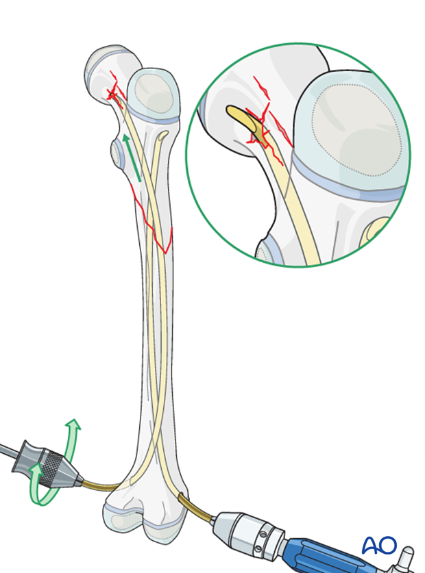 Pitfall: penetration of femoral neck