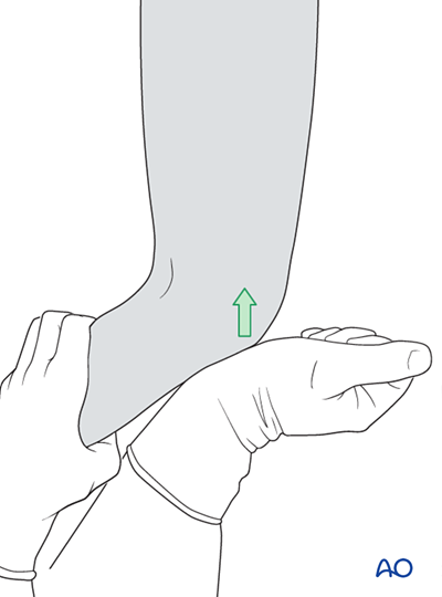 Locked intramedullary nailing (ALFN) for Complete transverse, simple