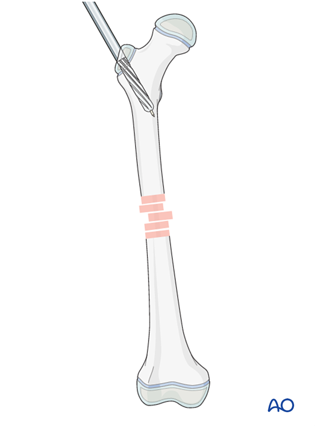Overreaming of the proximal femur