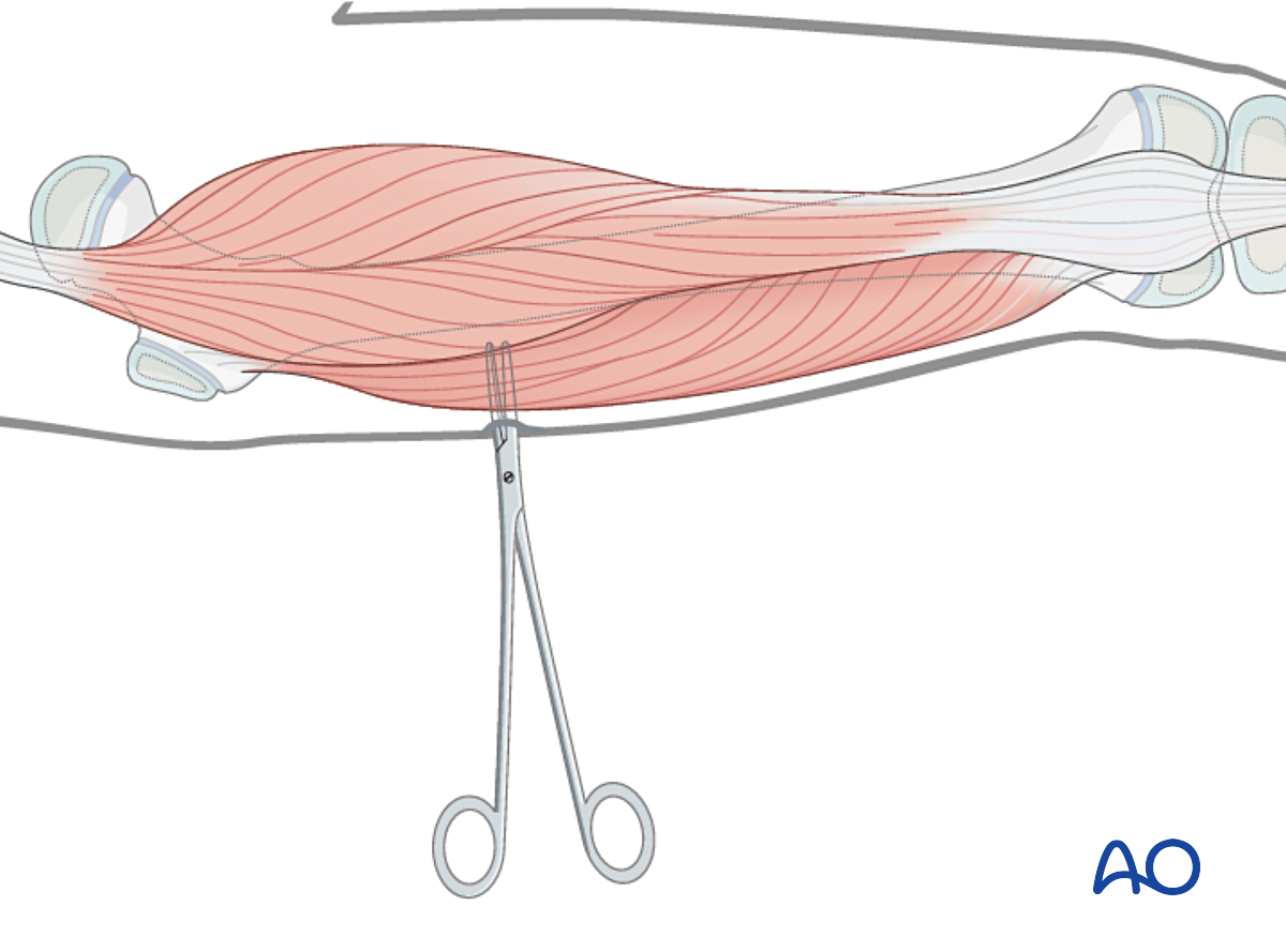 External Fixation For Complete Transverse, Simple