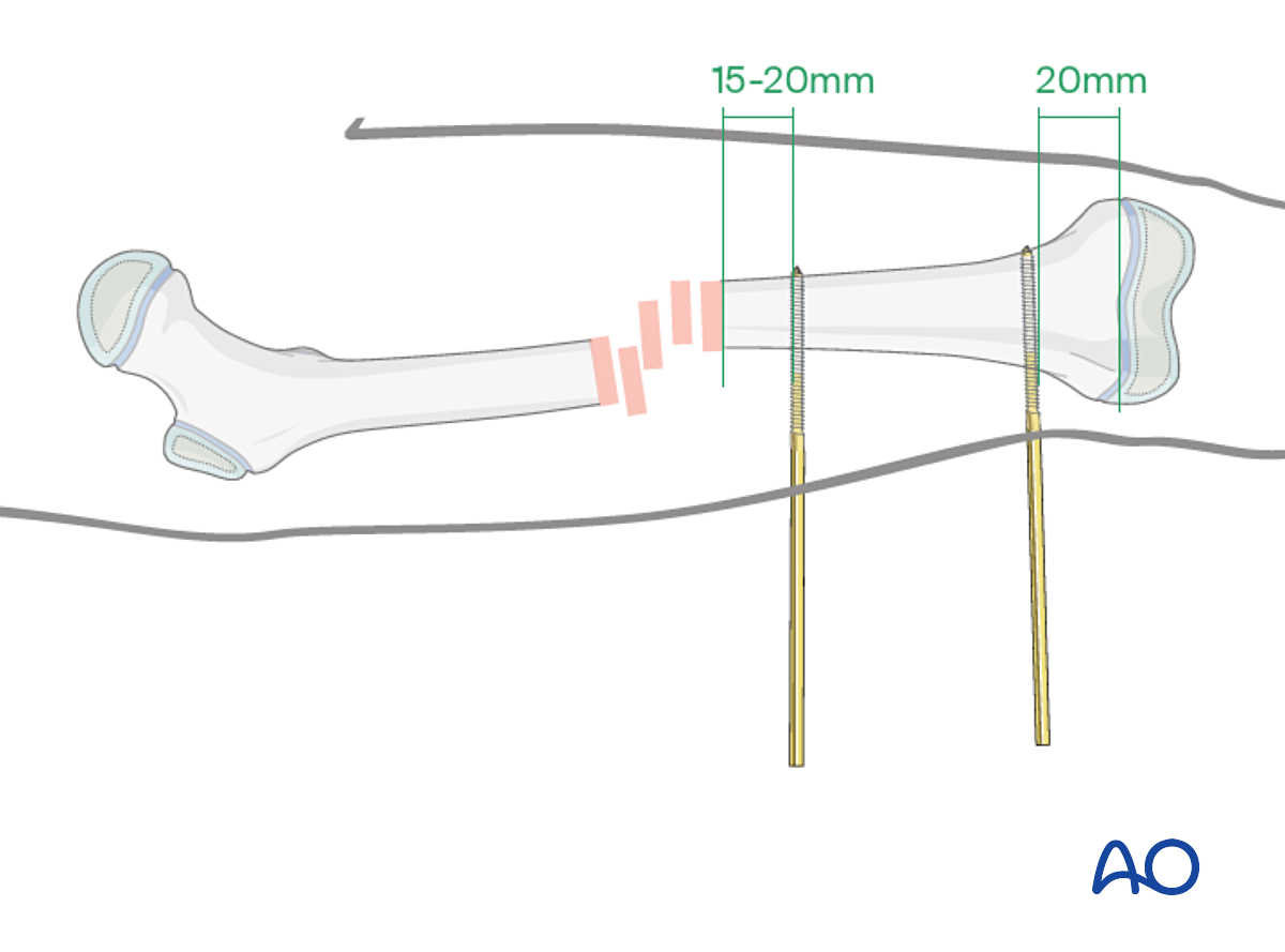 External Fixation For Complete Transverse, Simple