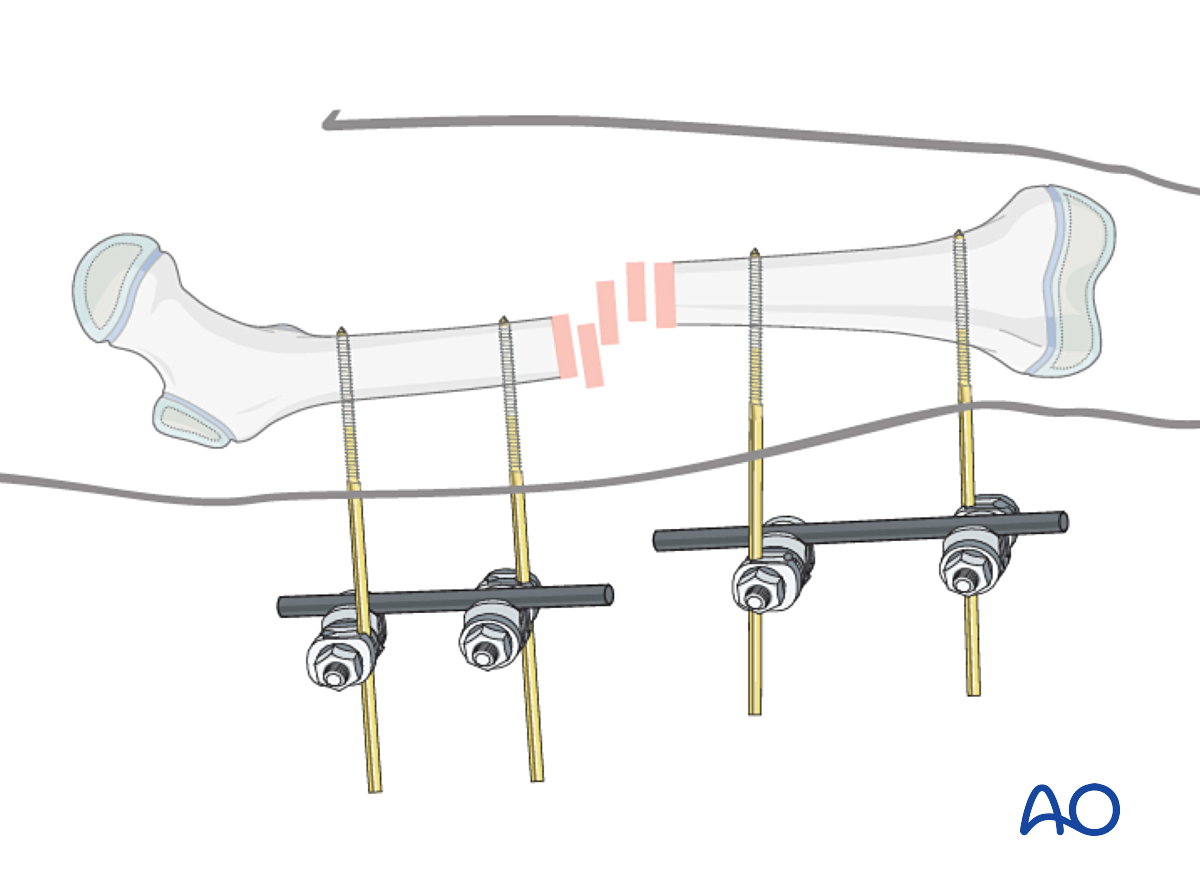 External Fixation For Complete Transverse, Simple