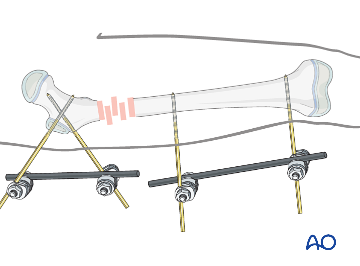 External Fixation For Complete Transverse, Simple