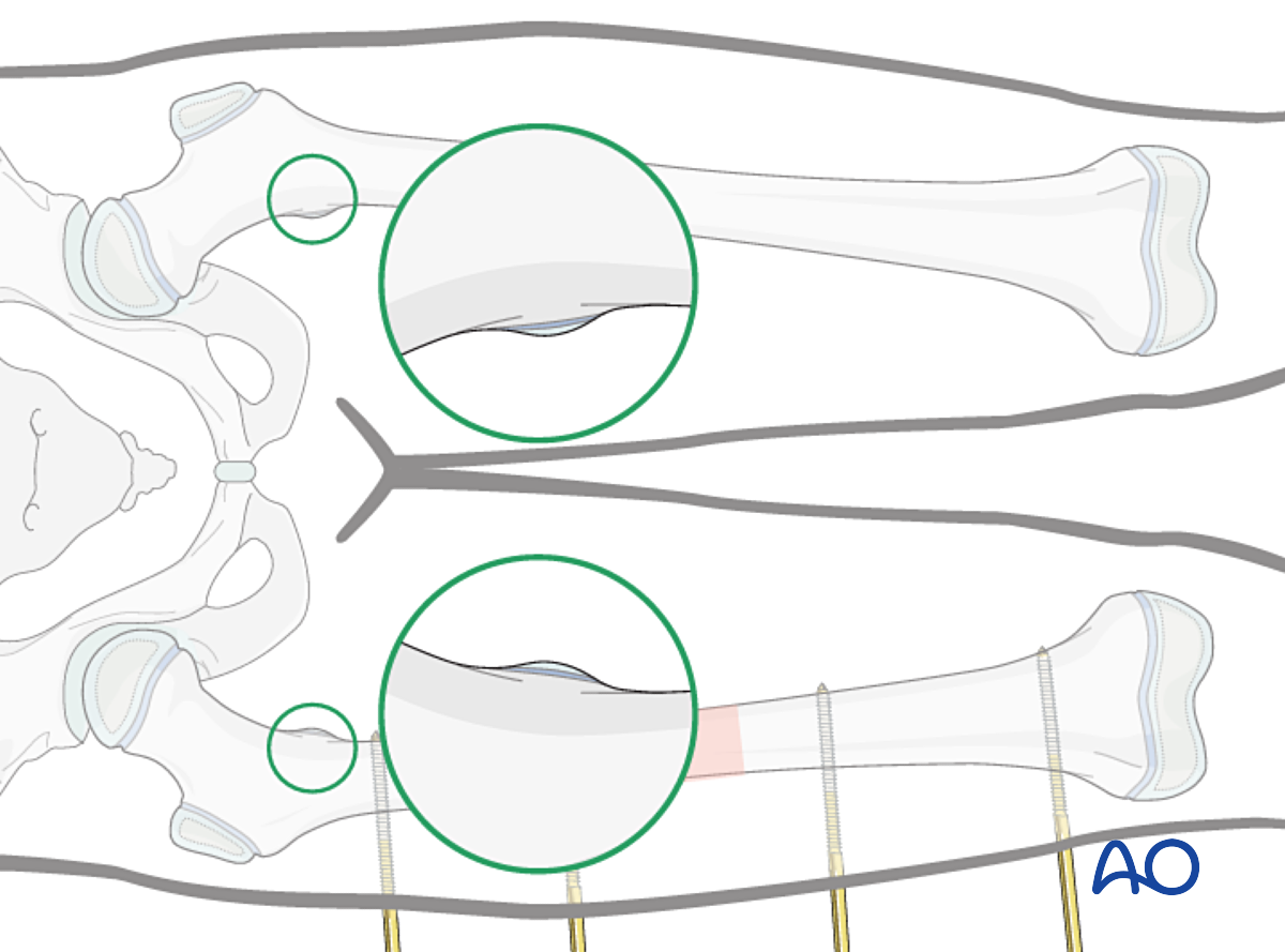 External Fixation For Complete Transverse, Simple