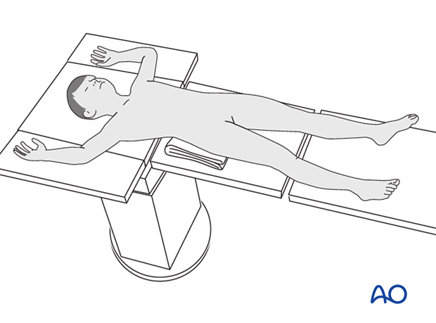 Supine patient position on a radiolucent fractures table without traction