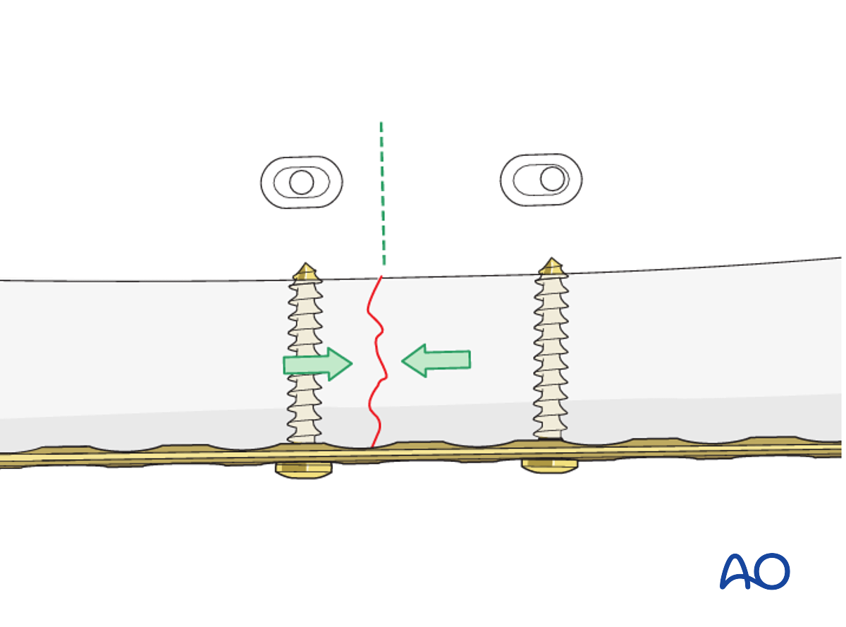 Open Reduction; Plate Fixation For Complete Transverse, Simple