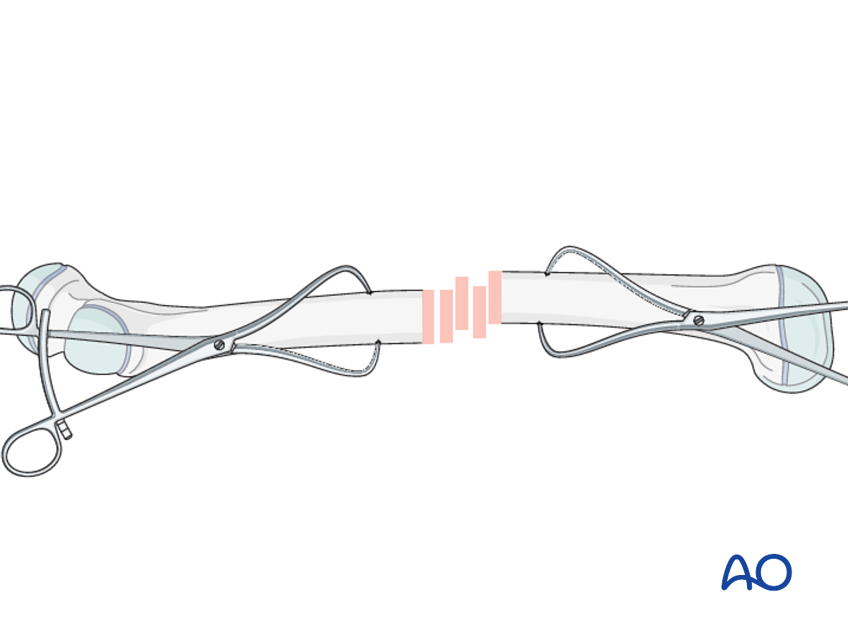 Open Reduction; Plate Fixation For Complete Transverse, Simple