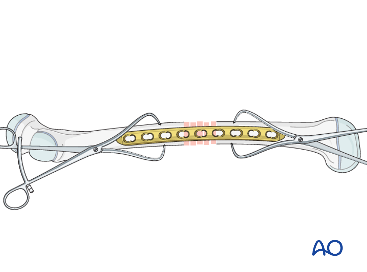 Open Reduction; Plate Fixation For Complete Transverse, Simple