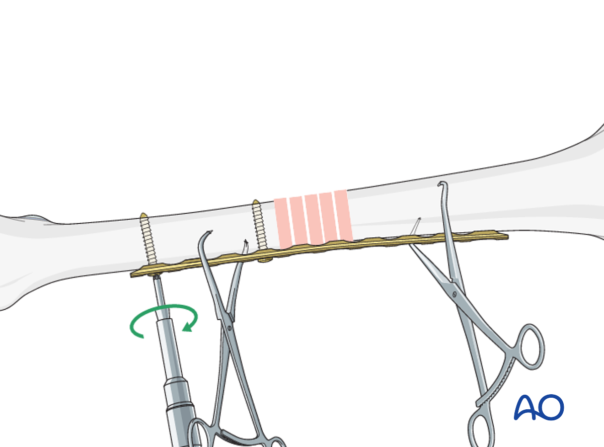 Open Reduction; Plate Fixation For Complete Transverse, Simple