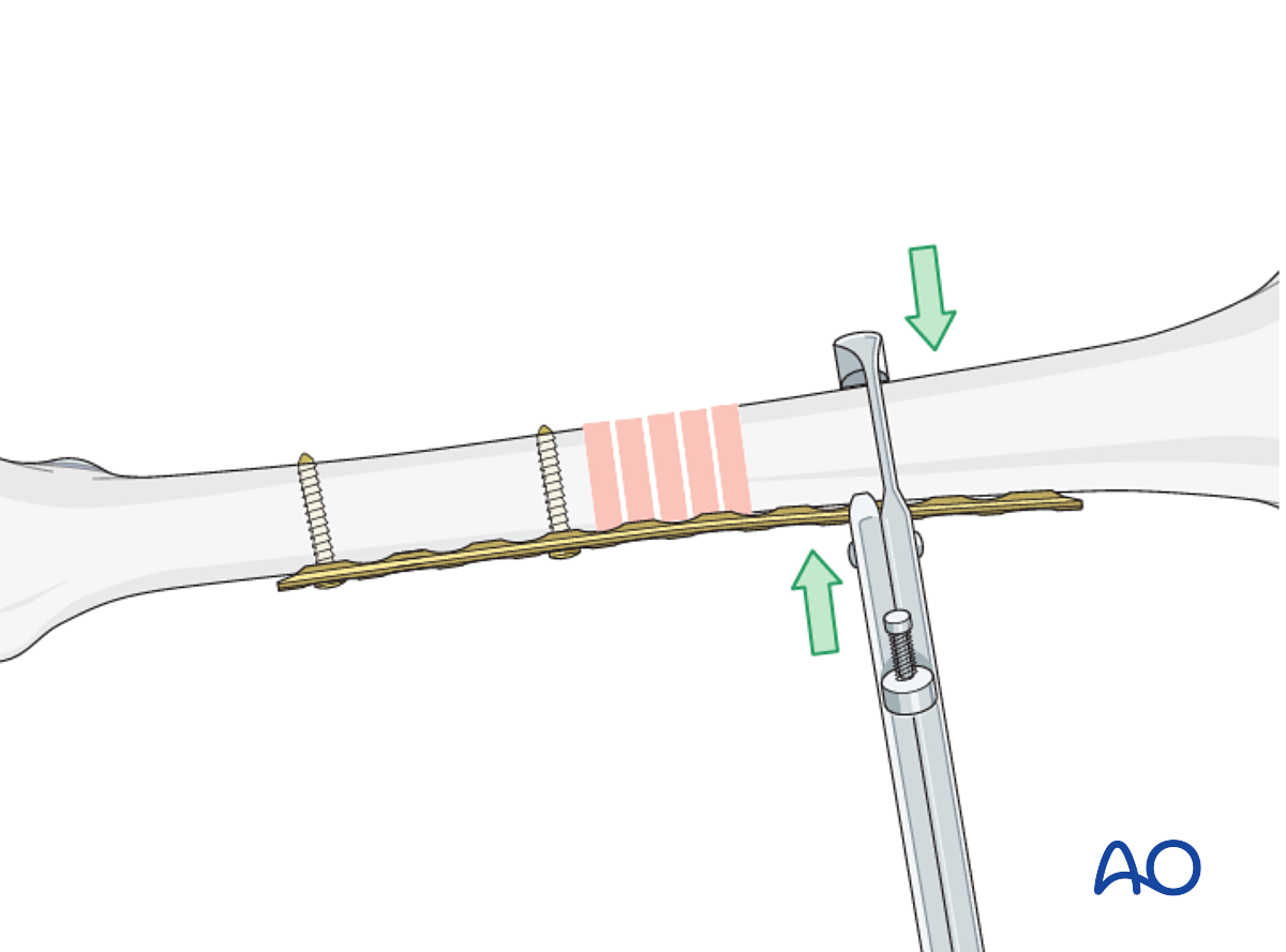 Open Reduction; Plate Fixation For Complete Transverse, Simple