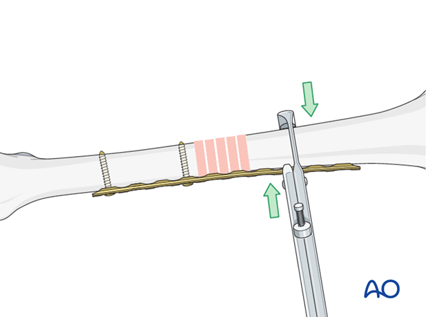 Temporary fixation with a bone holding forceps