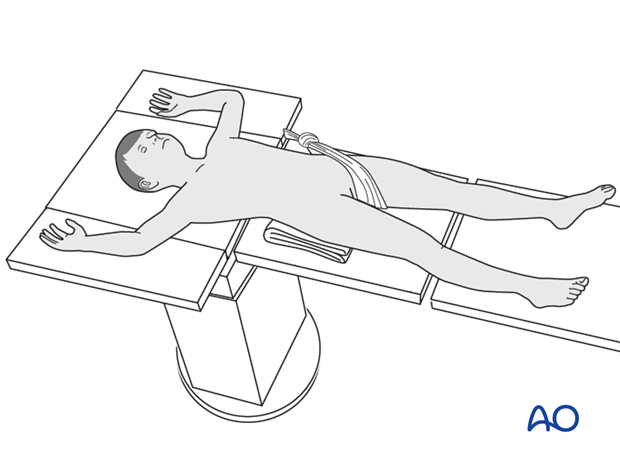 Patient position on a radiolucent fracture table