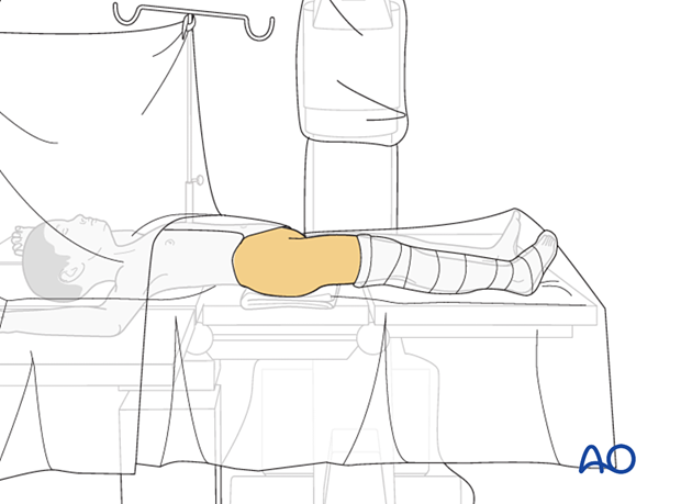 Skin preparation and draping with the patient positioned supine