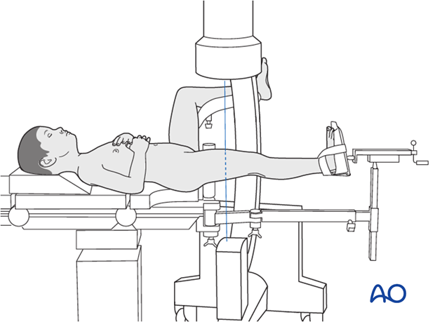 Supine patient position on a traction table