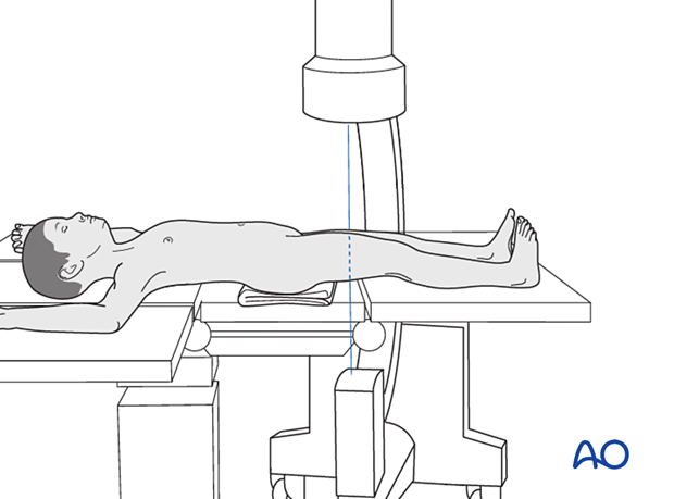 Supine patient position on a radiolucent fracture table with C-arm positioning 
