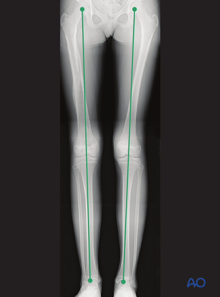 External Fixation For Complete Transverse, Simple